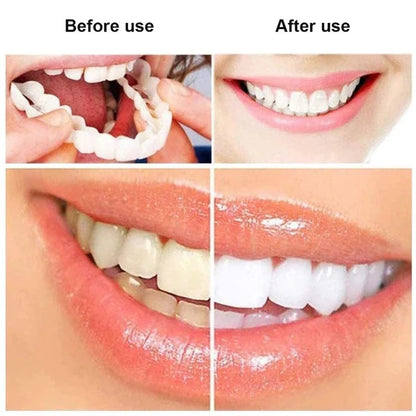 Carillas Postiza Dentadura SnapOn Smile